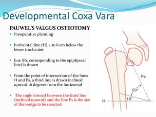 Developmental Coxa Vara
PAUWEL’S VALGUS OSTEOTOMY
 Preoperative planning
 horizontal line (H) 4 to 6 cm below the
lesser trochanter
 line (Ps, corresponding to the epiphyseal
line) is drawn
 From the point of intersection of the lines
H and Ps, a third line is drawn inclined
upward 16 degrees from the horizontal
 The angle formed between the third line
(inclined upward) and the line Ps is the size
of the wedge to be resected
 