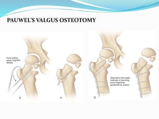 PAUWEL’S VALGUS OSTEOTOMY
 