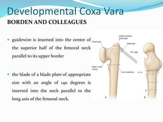 Developmental Coxa Vara
BORDEN AND COLLEAGUES
 guidewire is inserted into the center of
the superior half of the femoral neck
parallel to its upper border
 the blade of a blade plate of appropriate
size with an angle of 140 degrees is
inserted into the neck parallel to the
long axis of the femoral neck.
 