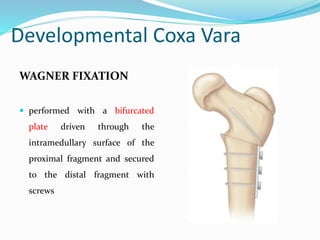 Developmental Coxa Vara
WAGNER FIXATION
 performed with a bifurcated
plate driven through the
intramedullary surface of the
proximal fragment and secured
to the distal fragment with
screws
 
