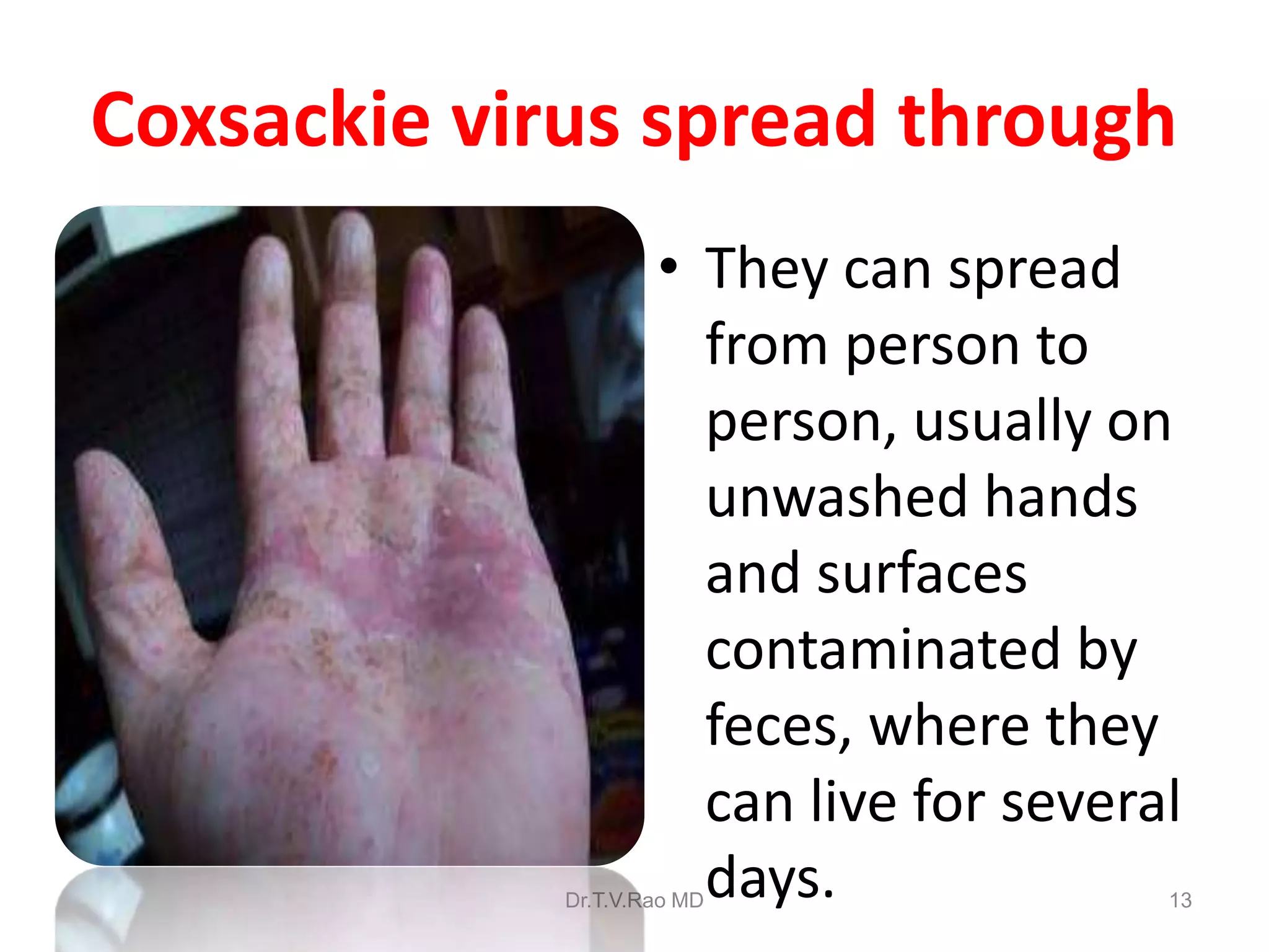 Coxsackievirus (2).ppt