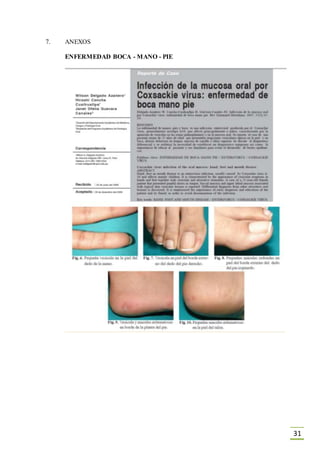 31
7. ANEXOS
ENFERMEDAD BOCA - MANO - PIE
 