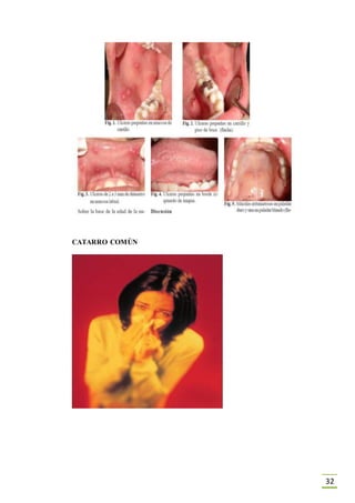 32
CATARRO COMÙN
 