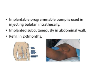 • Implantable programmable pump is used in
injecting balofan intrathecally.
• Implanted subcutaneously in abdominal wall.
• Refill in 2-3months.
 