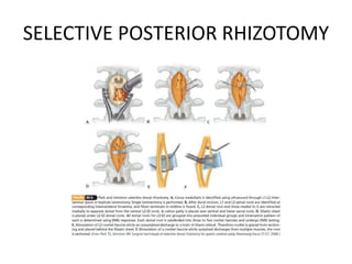 SELECTIVE POSTERIOR RHIZOTOMY
 