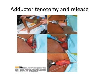 Adductor tenotomy and release
 