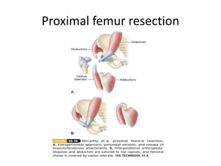 Proximal femur resection
 