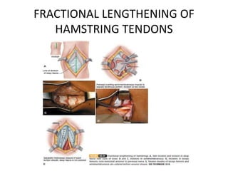 FRACTIONAL LENGTHENING OF
HAMSTRING TENDONS
 