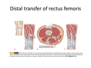 Distal transfer of rectus femoris
 