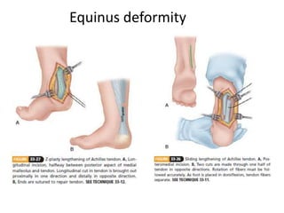 Equinus deformity
 