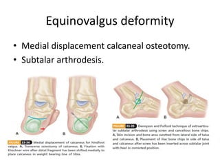 Equinovalgus deformity
• Medial displacement calcaneal osteotomy.
• Subtalar arthrodesis.
 