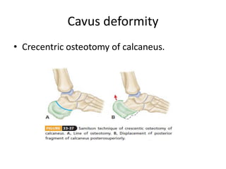 Cavus deformity
• Crecentric osteotomy of calcaneus.
 