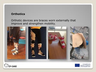 Orthotics
Orthotic devices are braces worn externally that
improve and strengthen mobility.
 
