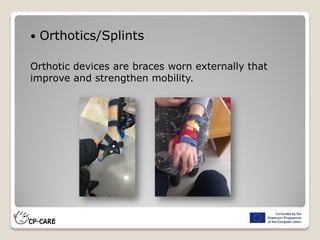  Orthotics/Splints
Orthotic devices are braces worn externally that
improve and strengthen mobility.
 