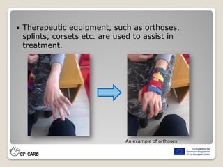  Therapeutic equipment, such as orthoses,
splints, corsets etc. are used to assist in
treatment.
An example of orthoses
 