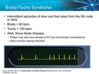 Tachy Fast Drawing CP1-Bradyarrhythmias-and-Pacemaker-Indications-2012.ppt
