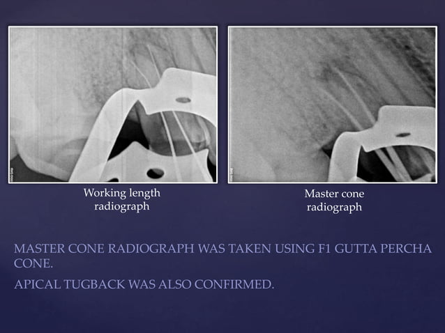 Intraoral Dental Sinus _ Definition and management of odontogenic ...