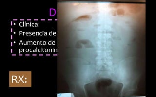 Diagnostico
• Clínica
• Presencia de leucocitosis con neutrofilia
• Aumento de proteína C reactiva y
procalcitonina
RX:
 
