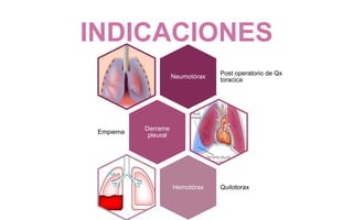 INDICACIONES
Neumotórax
Post operatorio de Qx
toracica
Derrame
pleural
Empiema
Hemotórax Quilotorax
 