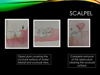 SCALPEL
11
Operculum covering the
occlusal surface of molar-
lateral and occlusal view.
Complete removal
of the operculum
clearing the occlusal
surface
 