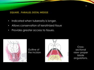 SQUARE , PARALLEL DISTAL WEDGE
• Indicated when tuberosity is longer.
• Allows conservation of keratinized tissue
• Provides greater access to tissues.
25
Cross-
sectional
view- proper
blade
angulations.
Outline of
the incision
 