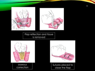 26
Flap reflection and tissue
is removed
osseous
correction
Sutures placed to
close the flap
 