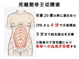 死戦期帝王切開術
妊娠 20 週以降に適応あり
CPA から４分で手術開始
５分目で胎児娩出を目標
分娩後の子宮収縮により
母体への血流が回復する
 