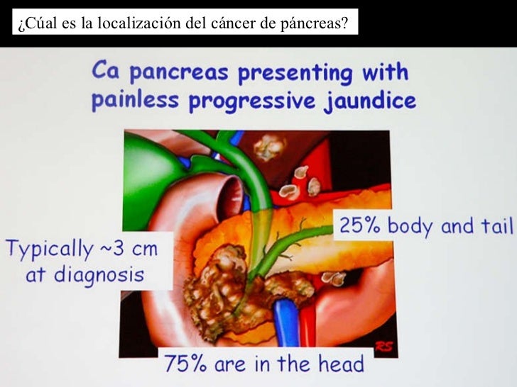 Ca pancreas y diabetes Ca pancreas y diabetes