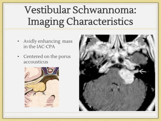 Vestibular Schwannoma:
Imaging Characteristics
• Avidly enhancing mass
in the IAC-CPA
• Centered on the porus
accousticus
 