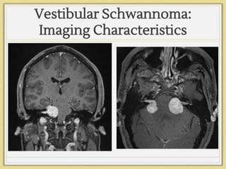 Vestibular Schwannoma:
Imaging Characteristics
 