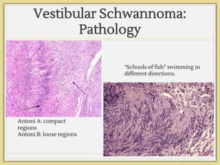 Vestibular Schwannoma:
Pathology
Antoni A: compact
regions
Antoni B: loose regions
“Schools of fish” swimming in
different directions.
 