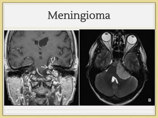 Meningioma
 
