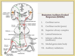 Brainstem Auditory Evoked
Responses (BAERs)
I. Cochlear nerve
II. Cochlear nuclei (pons)
III. Superior olivary complex
IV. Lateral lemniscus
V. Inferior colliculus
(midbrain)
VI. Medial geniculate body
VII. Auditory radiations
 