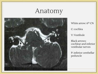 Anatomy
White arrow: 6th CN
C: cochlea
V: Vestibule
Black arrows:
cochlear and inferior
vestibular nerves
P: inferior cerebellar
peduncle
 
