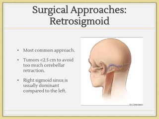 Surgical Approaches:
Retrosigmoid
• Most common approach.
• Tumors <2.5 cm to avoid
too much cerebellar
retraction.
• Right sigmoid sinus is
usually dominant
compared to the left.
 