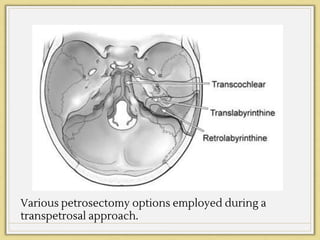 Various petrosectomy options employed during a
transpetrosal approach.
 