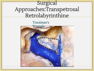 Surgical
Approaches:Transpetrosal
Retrolabyrinthine
Trautman’s
Triangle
 