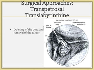 Surgical Approaches:
Transpetrosal
Translabyrinthine
• Opening of the dura and
removal of the tumor
 