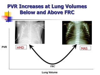 PVR Increases at Lung Volumes
Below and Above FRC
PVR
Lung Volume
FRC
HMD MAS
 