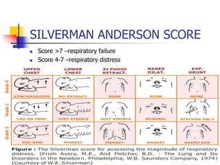 SILVERMAN ANDERSON SCORE
 Score >7 –respiratory failure
 Score 4-7 –respiratory distress
 