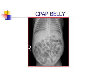 CPAP BELLY
 
