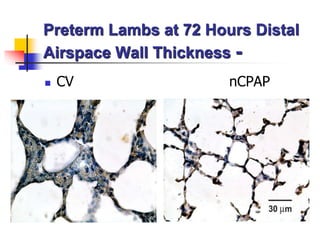 Preterm Lambs at 72 Hours Distal
Airspace Wall Thickness -
 CV nCPAP
 