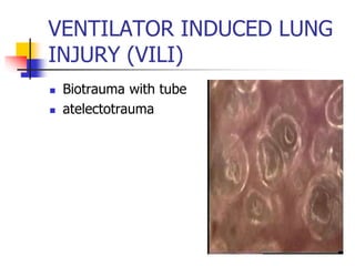 VENTILATOR INDUCED LUNG
INJURY (VILI)
 Biotrauma with tube
 atelectotrauma
 