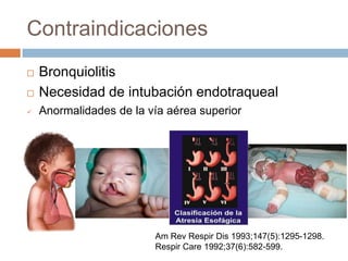 Surtimedik - El CPAP nasal en pediatría, principalmente busca mejorar la  ventilación a nivel alveolar y abrir la vía aérea superior. Existen  ventajas que suponen grandes beneficios en los efectos… Seguir leyendo