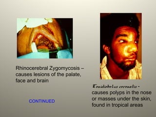 Rhinocerebral Zygomycosis –
causes lesions of the palate,
face and brain
Conidiobolus coronatis -
causes polyps in the nose
or masses under the skin,
found in tropical areas
CONTINUED
 