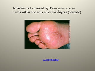 Athlete’s foot - caused by Tricophytom ruburm
• lives within and eats outer skin layers (parasite)
CONTINUED
 
