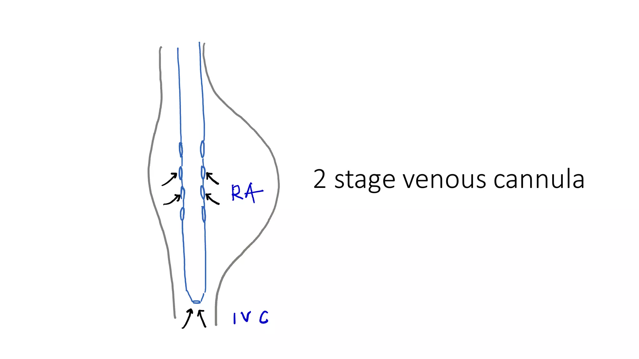 2 stage venous cannula
 