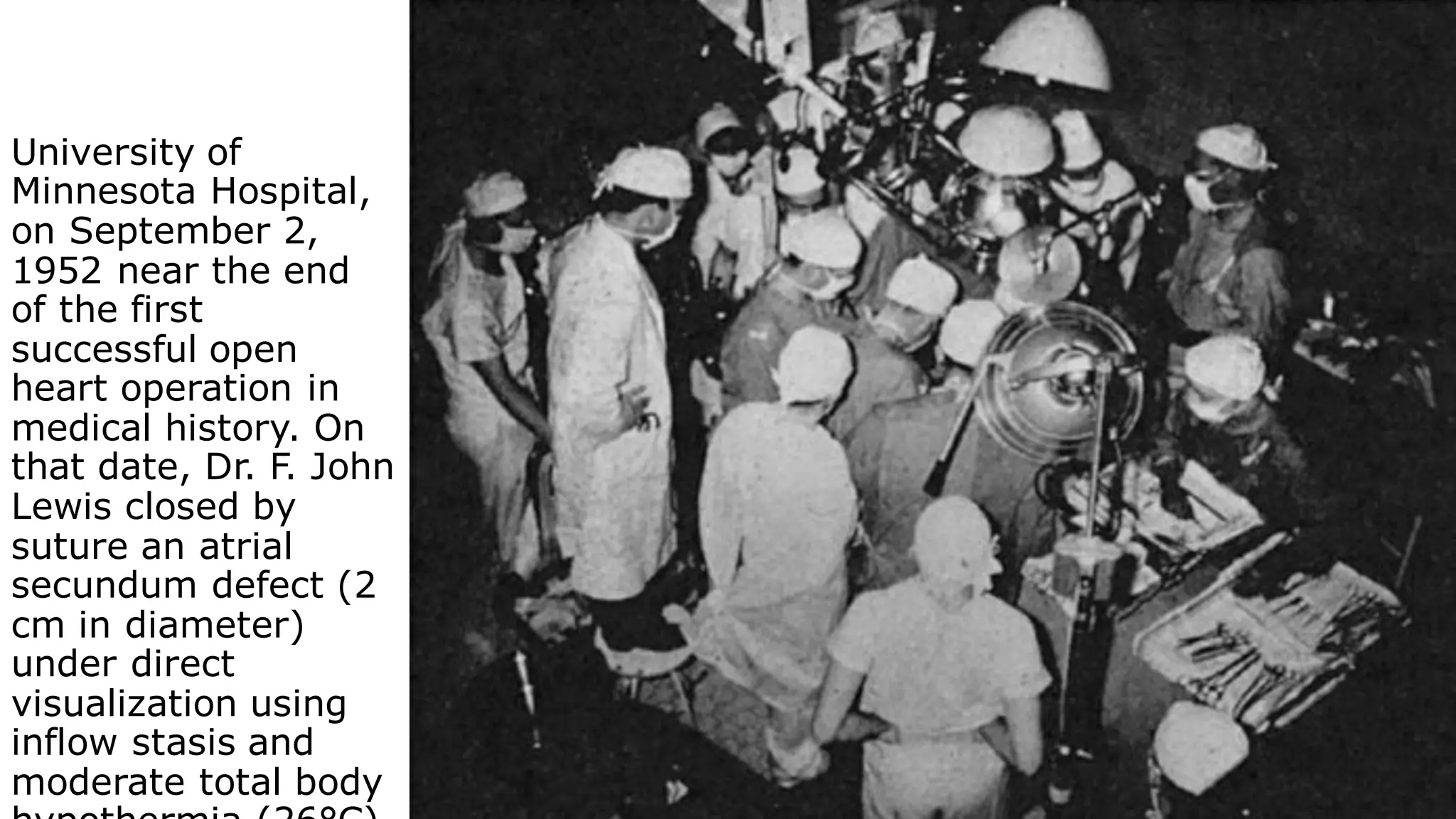 University of
Minnesota Hospital,
on September 2,
1952 near the end
of the first
successful open
heart operation in
medical history. On
that date, Dr. F. John
Lewis closed by
suture an atrial
secundum defect (2
cm in diameter)
under direct
visualization using
inflow stasis and
moderate total body
 
