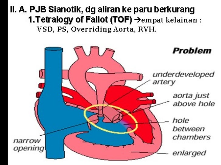 Tetralogi of fallot in CPB