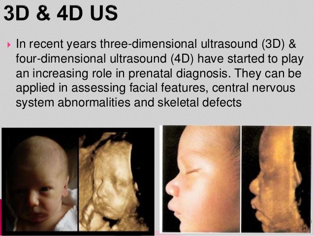 down syndrome 18 week ultrasound 4d down syndrome 18 week ultrasound 4d